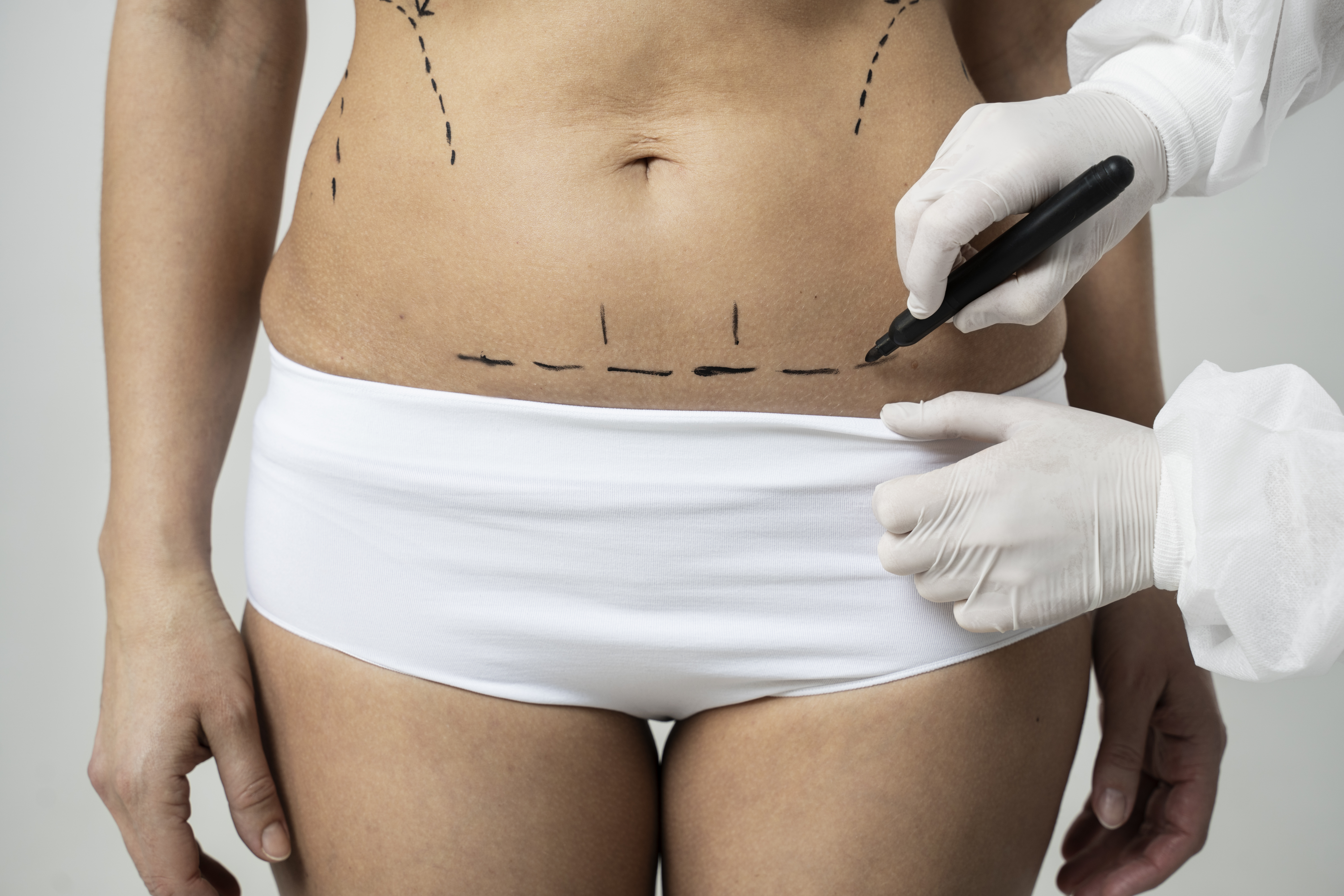 Tummy Tuck (Abdominoplasty)